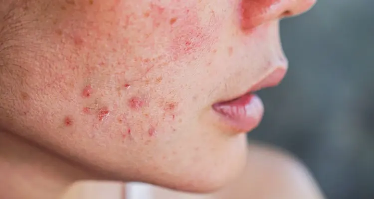 Beneath the Surface: A Comprehensive Exploration of Acne Varieties